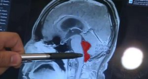أمريكا : أكتشاف دوددة شريطية في مخ رجل بعد معاناته 10 سنوات